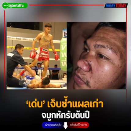 ‘เด่น’ เจ็บซ้ำแผลเก่า จมูกหักรับต้นปี